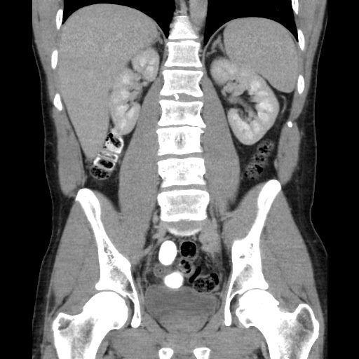 File:Appendicitis complicated by post-operative collection (Radiopaedia 35595-37113 B 34).jpg