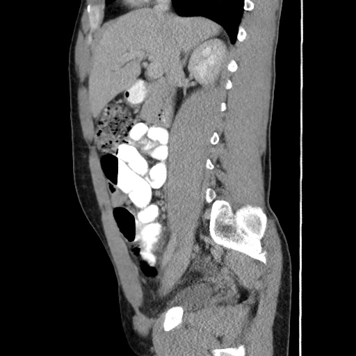 Appendicitis complicated by post-operative collection (Radiopaedia 35595-37114 C 30).jpg