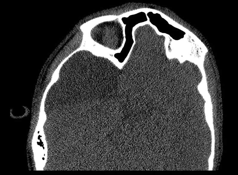 File:Arachnoid cyst- extremely large (Radiopaedia 68741-78450 Axial bone window 38).jpg