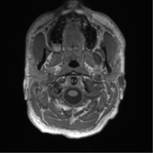 File:Arachnoid cyst with subdural hematoma (Radiopaedia 85892-101743 Axial T1 6).png