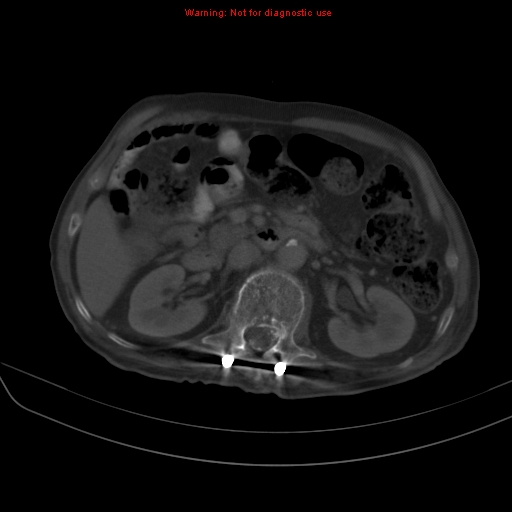 File:Arachnoiditis ossificans (Radiopaedia 51394-57136 Axial bone window 13).jpg