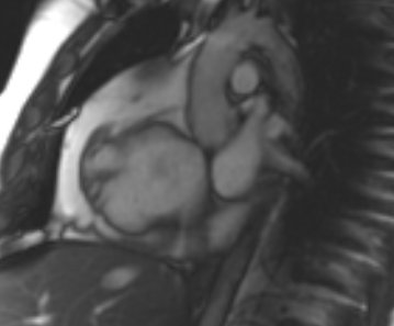Arrhythmogenic right ventricular cardiomyopathy (Radiopaedia 69431-79307 Short axis cine 221).jpg
