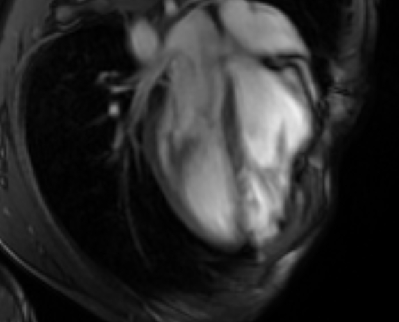 Arrhythmogenic right ventricular cardiomyopathy (Radiopaedia 69564-79464 4ch cine 51).jpg