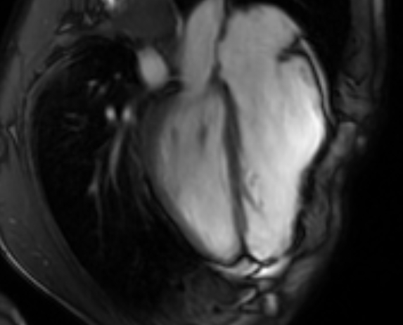 File:Arrhythmogenic right ventricular cardiomyopathy (Radiopaedia 69564-79464 4ch cine 96).jpg