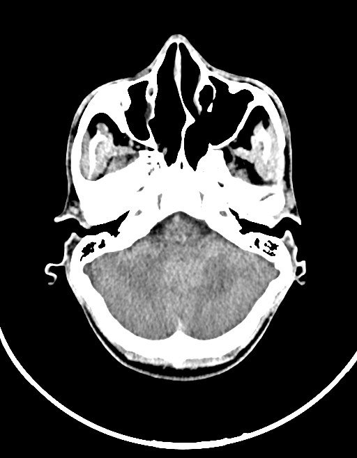 Arrow injury to the brain (Radiopaedia 72101-82607 Axial non-contrast 56).jpg