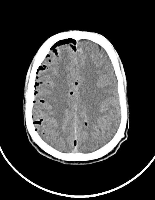 Arrow injury to the brain (Radiopaedia 72101-82607 Axial non-contrast 81).jpg