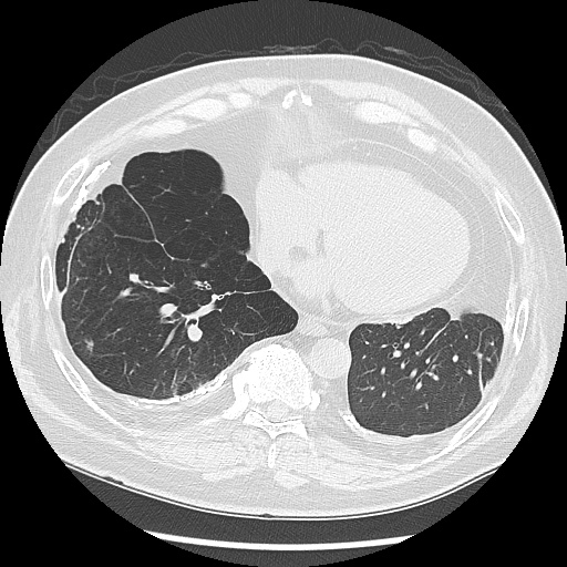 Asbestos-related pleural disease (Radiopaedia 74366-85250 Axial lung window 82).jpg