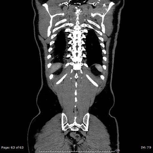 Ascending aortic aneurysm (Radiopaedia 50086-55404 B 63).jpg