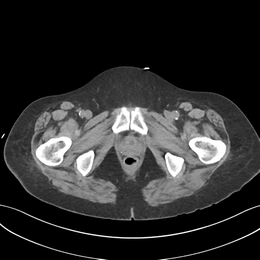 File:Ascending cholangitis (Radiopaedia 39068-41253 Axial non-contrast 70).png