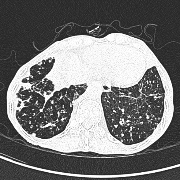 Aspergilloma- with Monod sign (Radiopaedia 44737-48532 Axial lung window 243).jpg