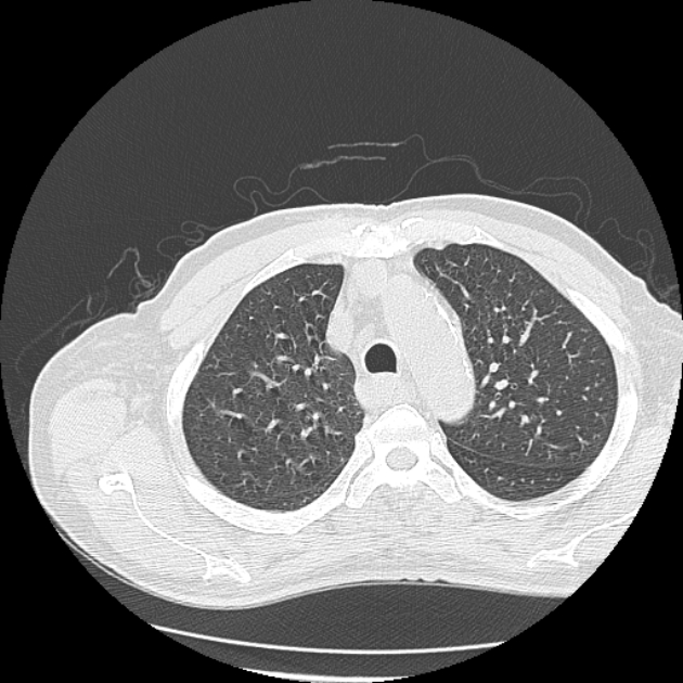 Aspergilloma (Radiopaedia 44592-48327 Axial lung window 18).jpg