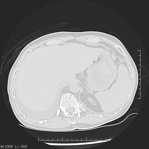 Aspergilloma (Radiopaedia 75184-86270 Axial lung window 51).jpg