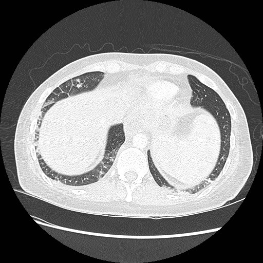 Aspiration pneumonia secondary to laparoscopic banding (Radiopaedia 18345-18183 lung window 93).jpg