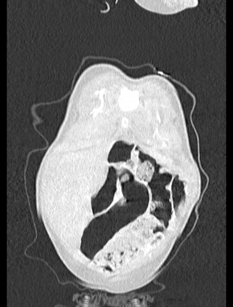 Asplenia syndrome (Radiopaedia 73083-83792 Coronal lung window 6).jpg