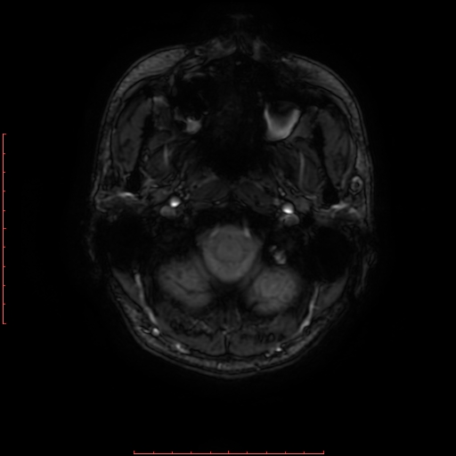 Astrocytoma NOS - cystic (Radiopaedia 59089-66384 Axial SWI 3).jpg