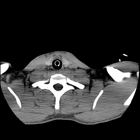 File:Atlanto-occipital dissociation (Traynelis type 1), C2 teardrop fracture, C6-7 facet joint dislocation (Radiopaedia 87655-104061 Axial non-contrast 75).jpg