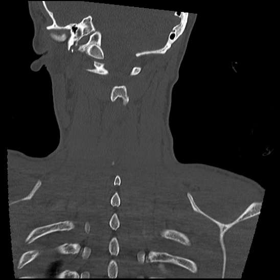 Atlanto-occipital dissociation (Traynelis type 1), C2 teardrop fracture, C6-7 facet joint dislocation (Radiopaedia 87655-104061 Coronal bone window 54).jpg