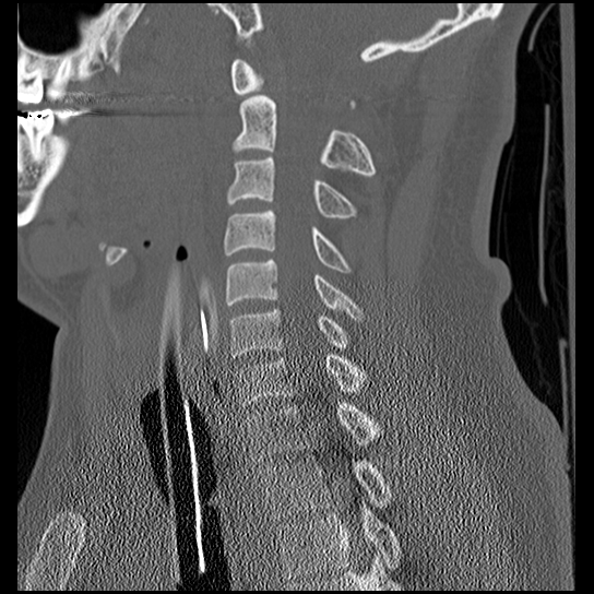 Atlanto-occipital dissociation injury (Radiopaedia 29274-29698 Sagittal bone window 31).png