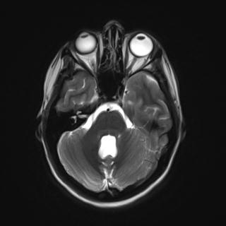 File:Atretic encephalocoele with inferior vermis hypoplasia (Radiopaedia 30443-31108 Axial T2 6).jpg