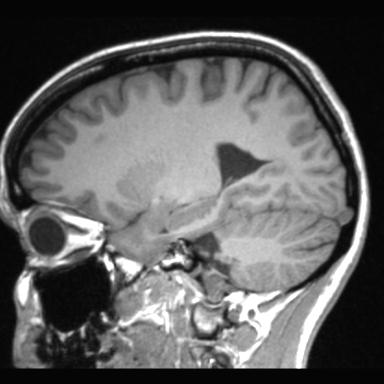 File:Atretic encephalocoele with inferior vermis hypoplasia (Radiopaedia 30443-31108 Sagittal T1 88).jpg