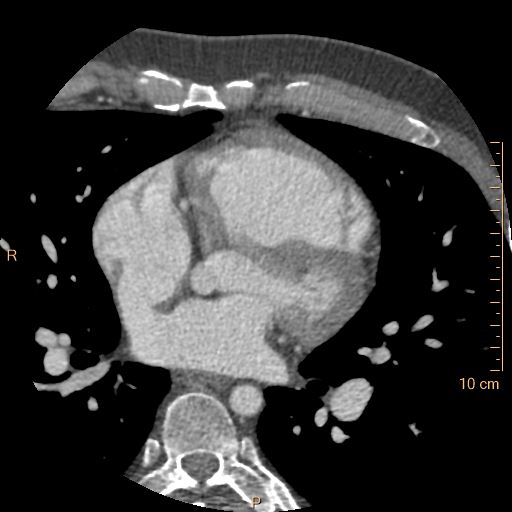 Atrial septal defect (upper sinus venosus type) with partial anomalous pulmonary venous return into superior vena cava (Radiopaedia 73228-83961 A 123).jpg