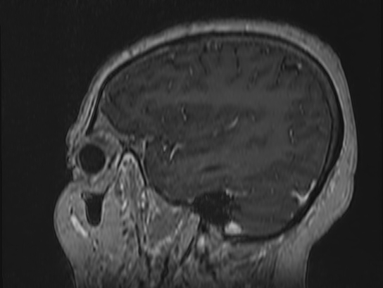 Atypical meningioma (Radiopaedia 62985-71406 Sagittal T1 C+ 16).jpg