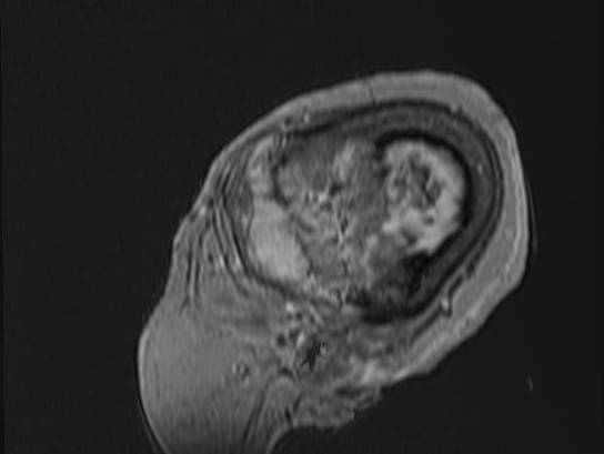 Atypical meningioma (Radiopaedia 62985-71406 Sagittal T1 C+ 95).jpg