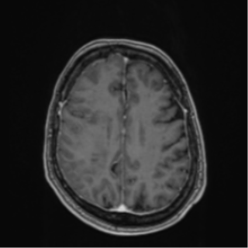 Atypical meningioma (WHO Grade II) (Radiopaedia 54742-60979 Axial T1 C+ 47).png