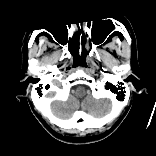 Atypical meningioma with skull invasion (Radiopaedia 34357-35649 Axial non-contrast 9).png
