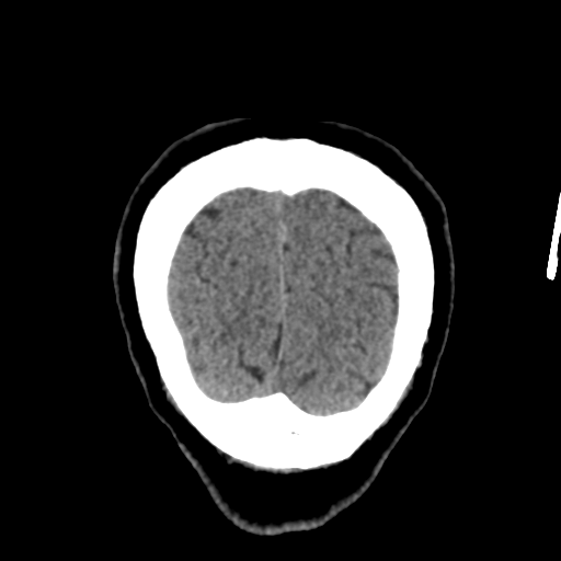 Atypical meningioma with skull invasion (Radiopaedia 34357-35649 Coronal non-contrast 58).png