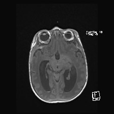 Atypical teratoid rhabdoid tumor (prenatal US and neonatal MRI) (Radiopaedia 59091-66388 Axial T1 27).jpg