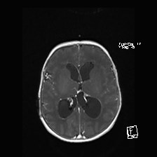 File:Atypical teratoid rhabdoid tumor (prenatal US and neonatal MRI) (Radiopaedia 59091-66388 Axial T1 C+ 35).jpg