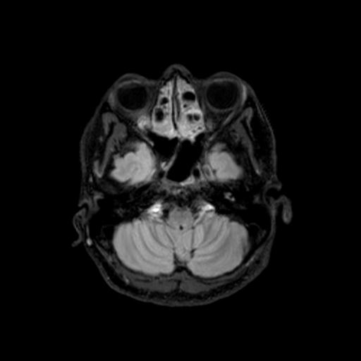 File:Autoimmune limbic encephalitis (Radiopaedia 30363-31005 Axial FLAIR 13).jpg
