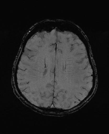 Autoimmune limbic encephalitis (Radiopaedia 30363-31005 SWI 52).jpg