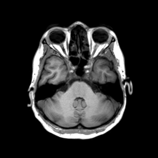 Autoimmune limbic encephalitis (Radiopaedia 30363-31005 T1 Axial 3mm 15).jpg