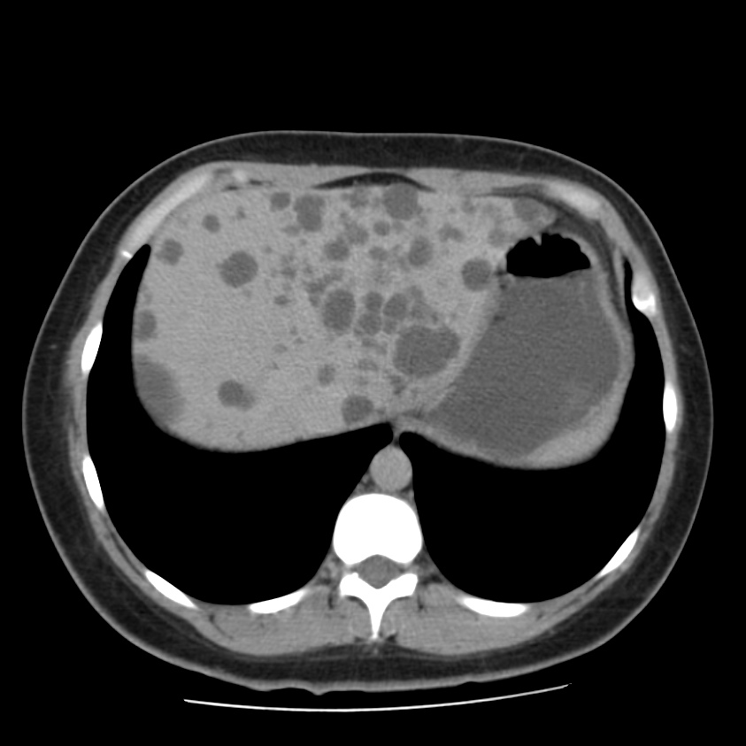 Autosomal dominant polycystic kidney disease (Radiopaedia 23061-23093 C+ delayed 11).jpg