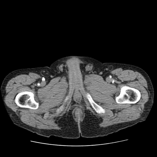 Autosomal dominant polycystic kidney disease (Radiopaedia 27851-28094 B 129).jpg