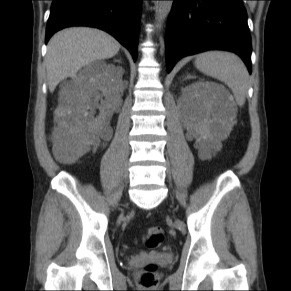 File:Autosomal dominant polycystic kidney disease (Radiopaedia 36539-38101 C 46).jpg