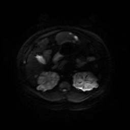 File:Autosomal dominant polycystic kidney disease (Radiopaedia 50259-55611 Axial DWI 54).jpg
