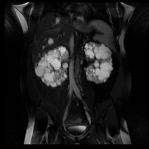 File:Autosomal dominant polycystic kidney disease (Radiopaedia 50259-55611 Coronal T2 fat sat 21).jpg
