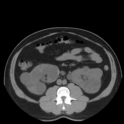 Autosomal dominant polycystic kidney disease (Radiopaedia 50259-55612 Axial non-contrast 44).jpg