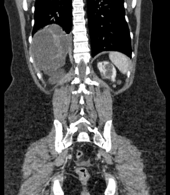 Autosomal dominant polycystic kidney disease (Radiopaedia 57124-64017 B 60).jpg