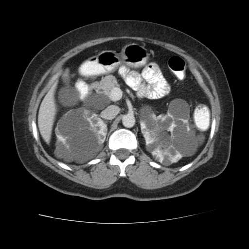 File:Autosomal dominant polycystic kidney disease with hepatic involvement (Radiopaedia 32693-33662 B 28).jpg