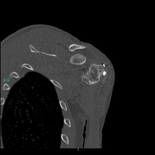 Avascular necrosis after fracture dislocations of the proximal humerus (Radiopaedia 88078-104655 Coronal bone window 99).jpg