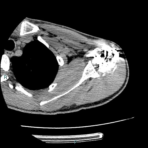 File:Avascular necrosis after fracture dislocations of the proximal humerus (Radiopaedia 88078-104655 D 47).jpg
