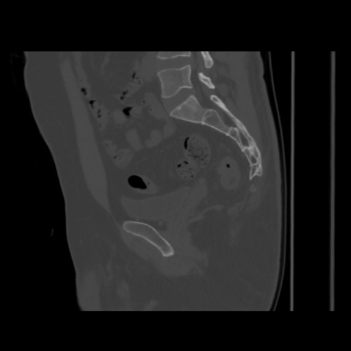 Avascular necrosis of the hip (Radiopaedia 61503-69467 B 28).jpg