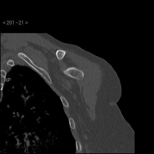 Avascular necrosis of the shoulder - Cruess stage I (Radiopaedia 77674-89887 Coronal bone window 20).jpg