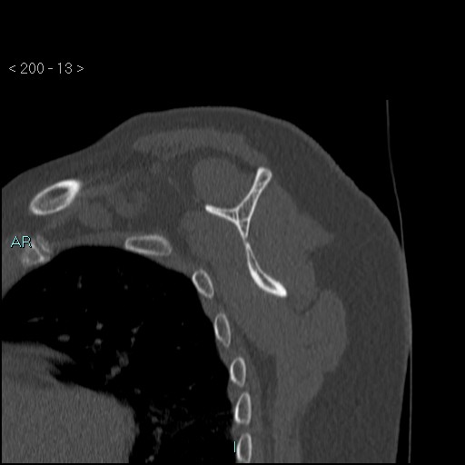Avascular necrosis of the shoulder - Cruess stage I (Radiopaedia 77674-89887 Sagittal bone window 12).jpg