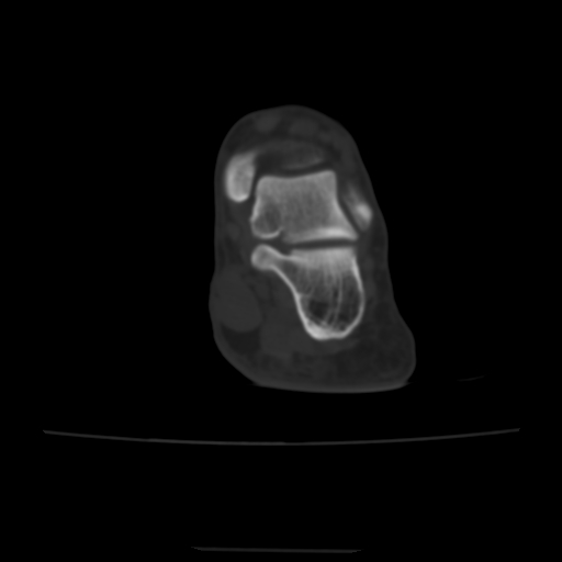 Avulsion fracture of the dorsal cuboid bone (Radiopaedia 51586-57377 Axial bone window 26).jpg