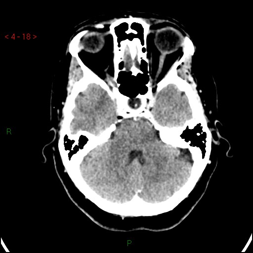 Azygos anterior cerebral artery (Radiopaedia 51987-57833 A 18).jpg